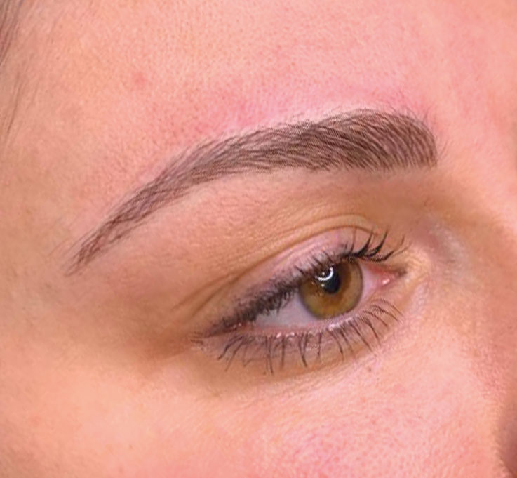 Fadenlifting Augenbrauen Vorher Nachher - Thread lift - Eye Brows 1